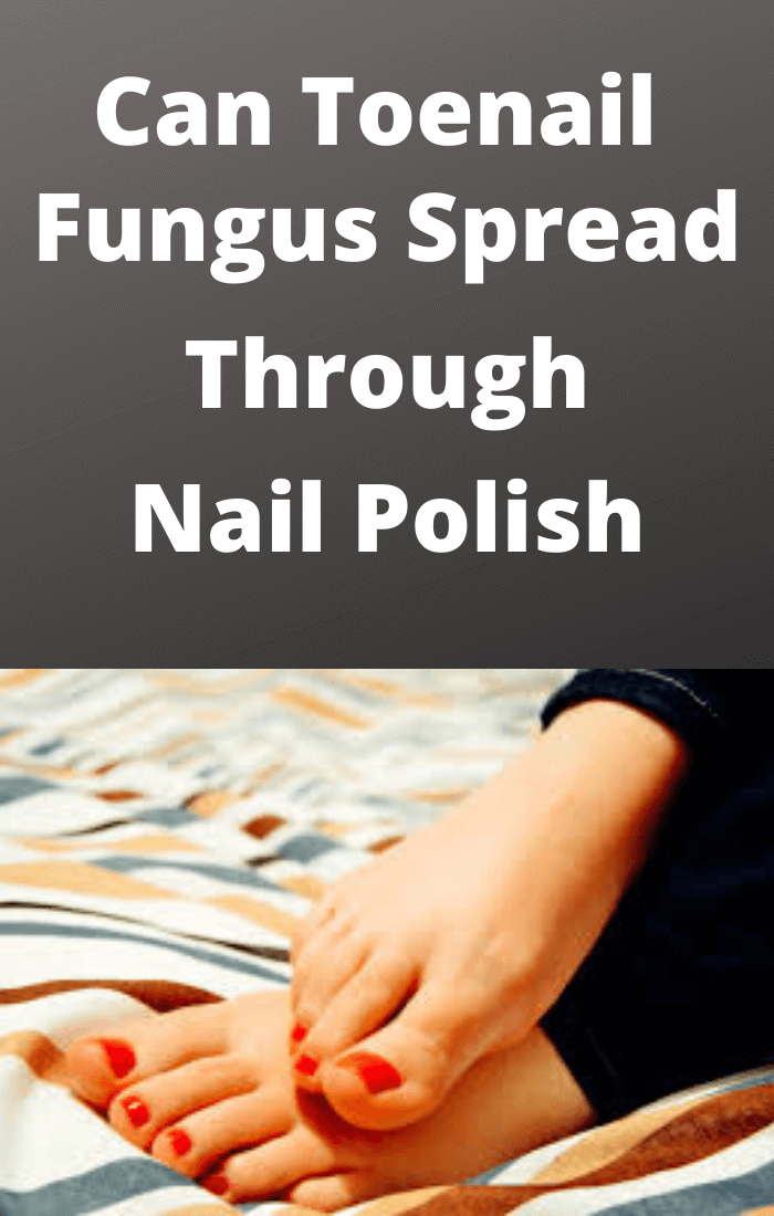 Can Toenail Fungus Spread Through Nail Polish? SHOCKING