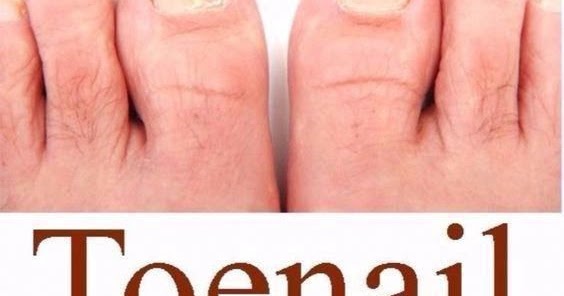 How To Get Rid Of Fungal Skin Infections
