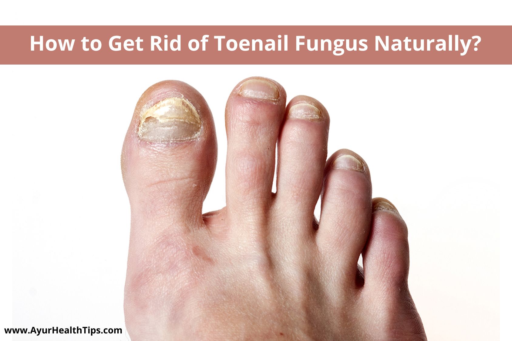 How To Get Rid Of Toenail Fungus Naturally â 8 Remedies ...