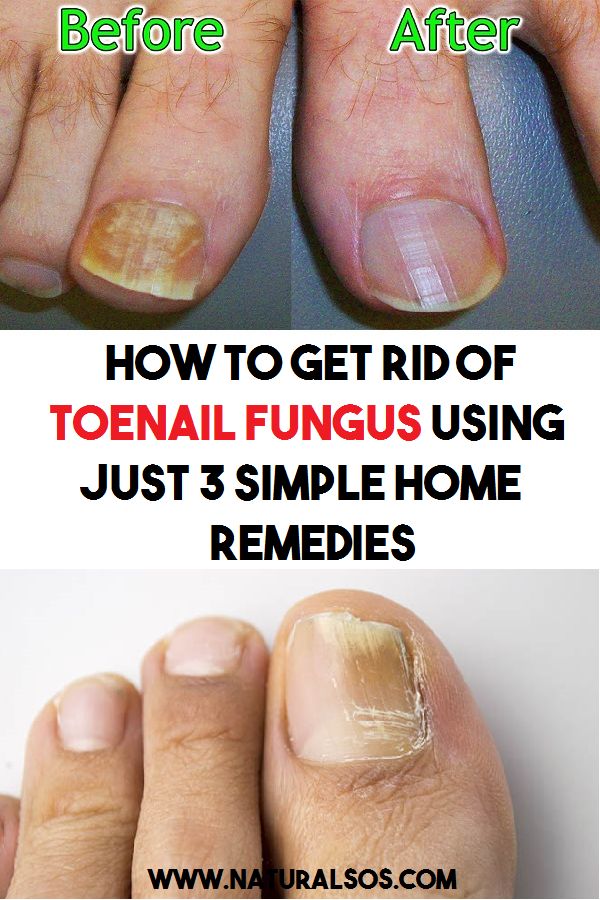 How to Get Rid of Toenail Fungus Using Just 3 Simple Home ...