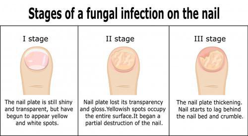 Is Toenail Fungus Contagious?: Neuhaus Foot &  Ankle: Podiatry